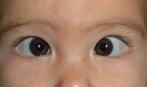 علت لوچ شدن چشم نوزاد
